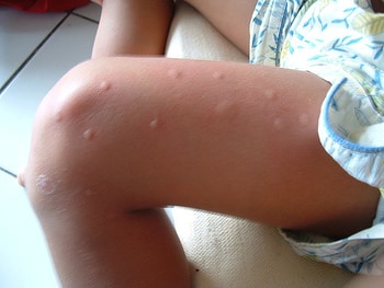 Mosquito Bite Kid's Leg